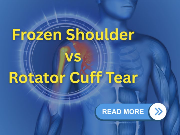 Frozen Shoulder vs Rotator Cuff Tear