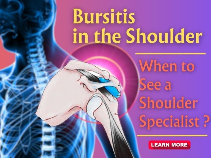 Bursitis in the Shoulder