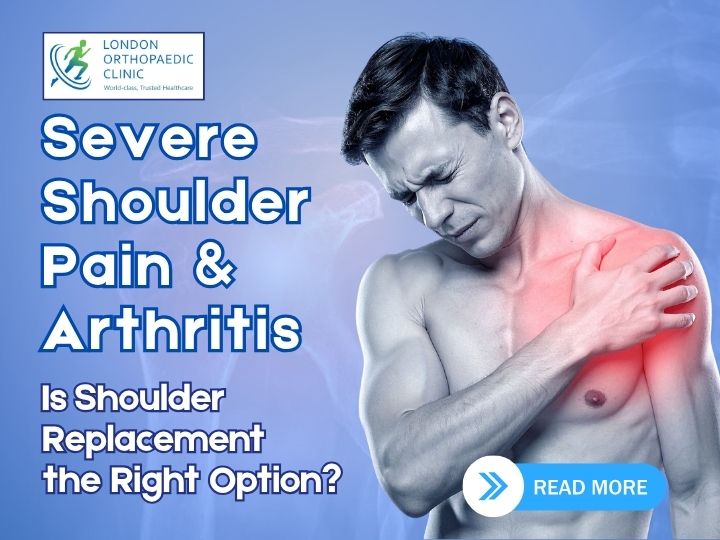 Severe Shoulder Pain & Arthritis: Is Shoulder Replacement the Right Option?