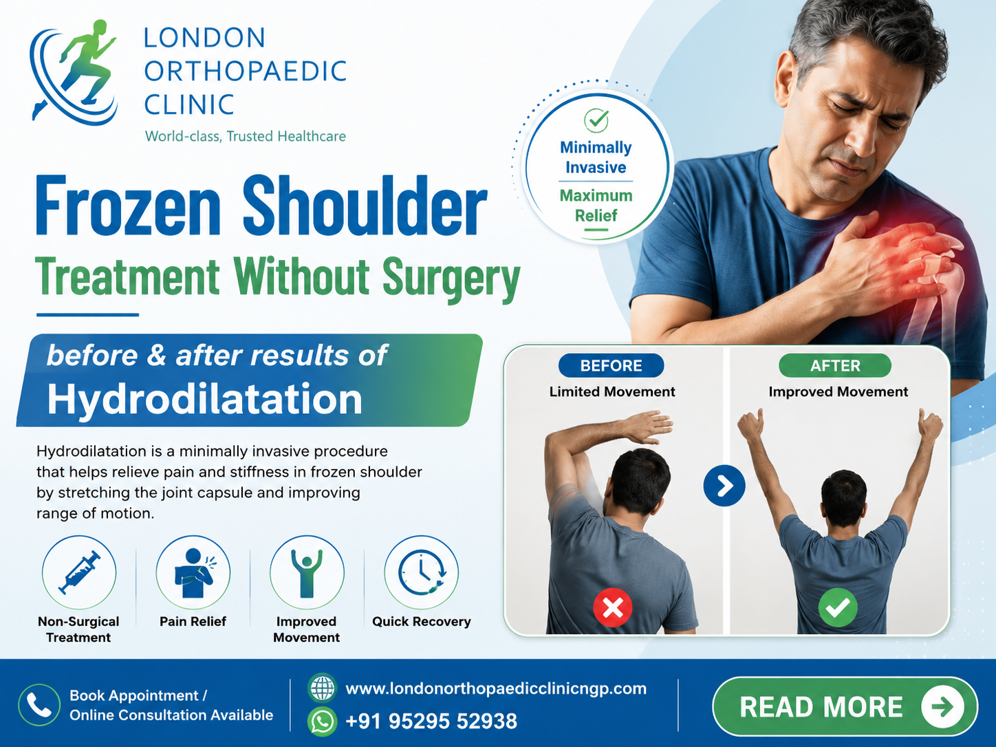 Non-Surgical Relief: Before & After Results of Hydrodilatation for Frozen Shoulder